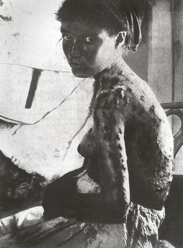 1909: jonge Armeense vrouw, bewerkt met messen tijdens de pogroms in Adana